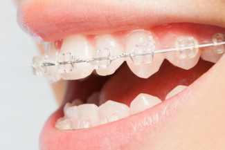 Clear Braces Abu Dhabi