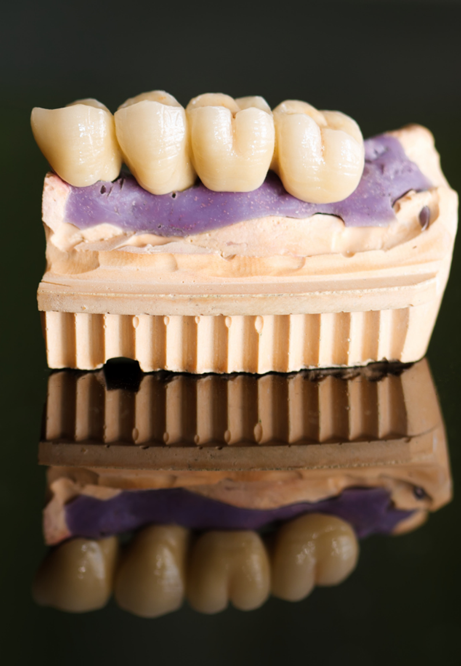 Dental Bridge and implant Abu Dhabi