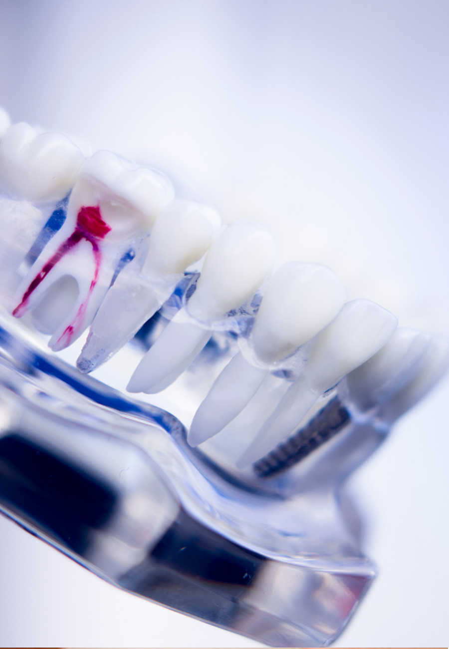 root canal treatment in Abu Dhabi