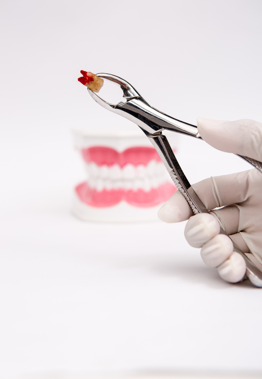 Tooth extraction in Abu Dhabi