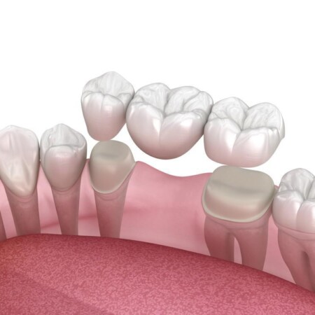 Dental bridge in Abu Dhabi