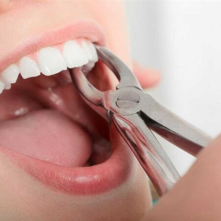 tooth extraction in Abu Dhabi