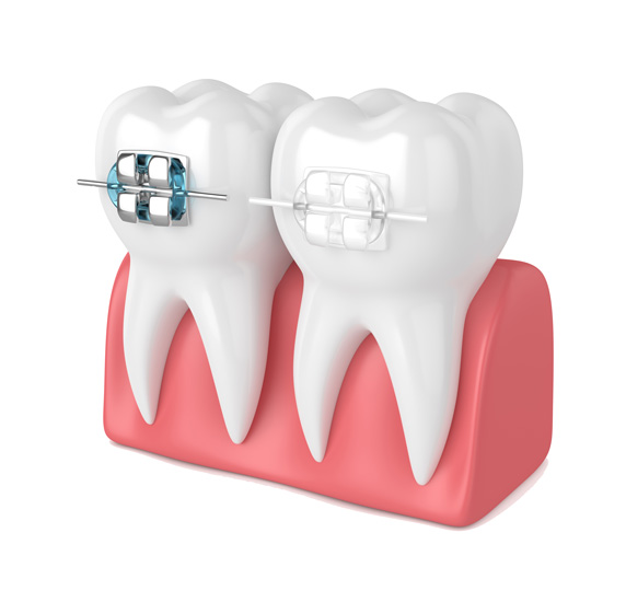 dental bracers in Abu Dhabi